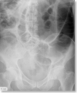 Large Bowel Obstruction