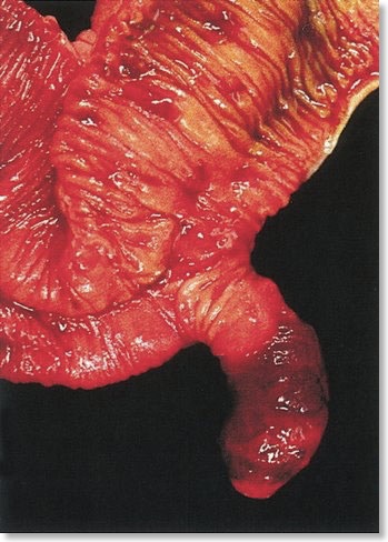 Meckel's Diverticulum
