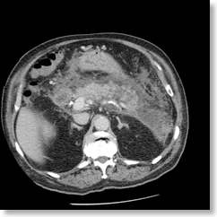 pancreatitis