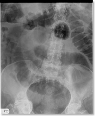 Small Bowel Obstruction